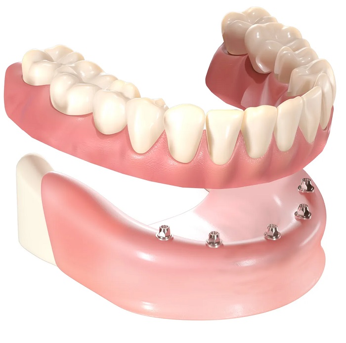 Implant-retained-denture